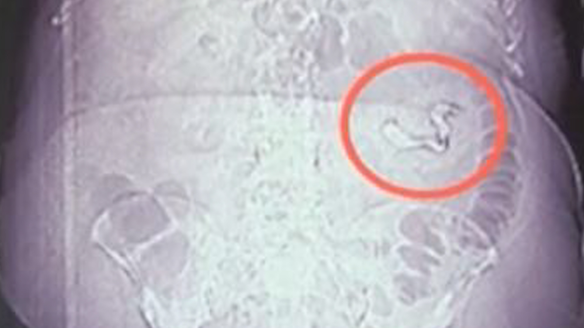 Duoc boi thuong 10 trieu USD vi y ta bo quen gac phau thuat trong bung hinh anh