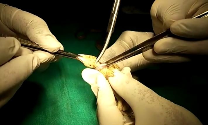 Phau thuat cuu ran bi rach co hong do co gang an tac ke hinh anh