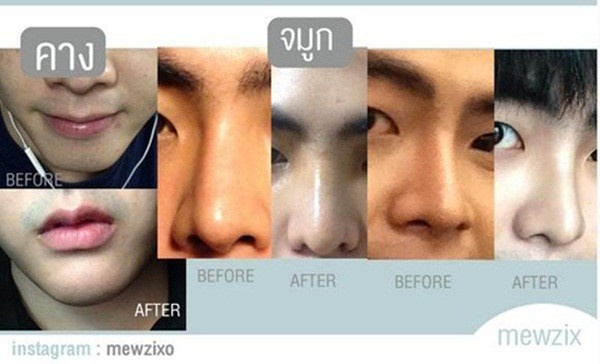 Chiếc mũi trở nên thẳng hơn. 