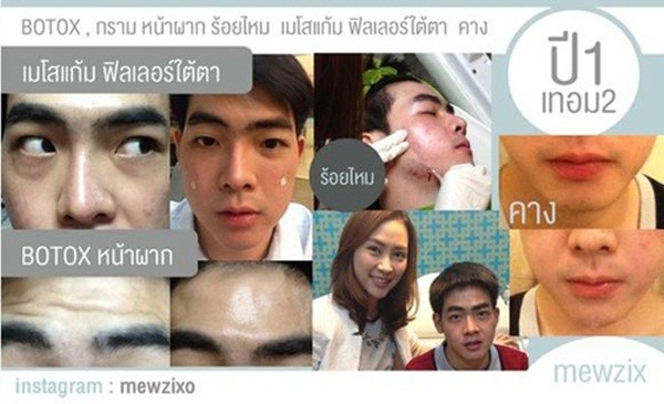 Ngoài sửa mũi và môi, chàng trai còn thực hiện bơm botox, gọt hàm và độn cằm.