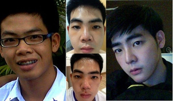 Sự khác biệt của Milliken trước và sau khi thực hiện phẫu thuật thẩm mỹ.