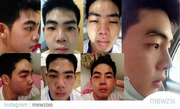 Những bức ảnh ghi lại vết thương của Milliken khiến người xem không khỏi sợ hãi.