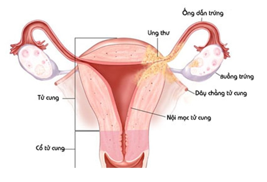 Một số bệnh phụ khoa như lạc nôi mạc tử cung gây đau bụng kinh.
