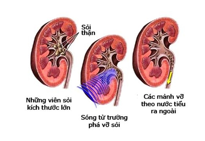 Lua chon dung phuong phap dieu tri benh soi than hinh anh