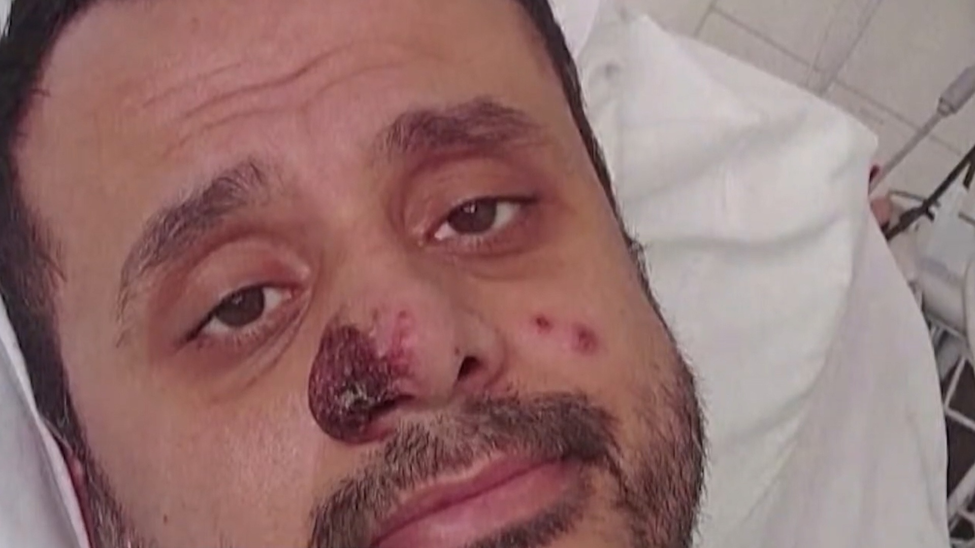 3 trieu chung nghiem trong cua benh dau mua khi moi duoc phat hien hinh anh