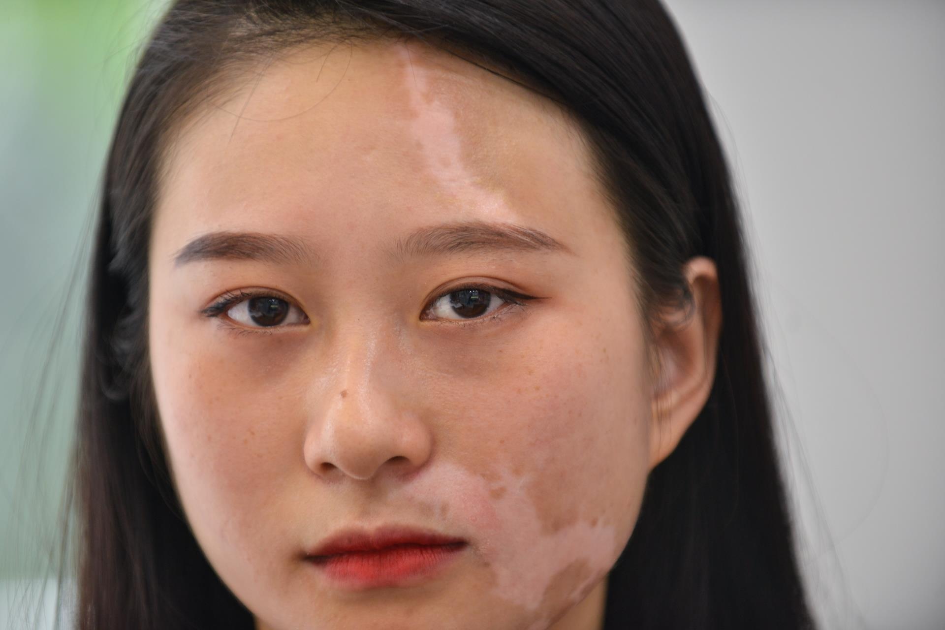 Vuot qua can benh bach bien anh 3