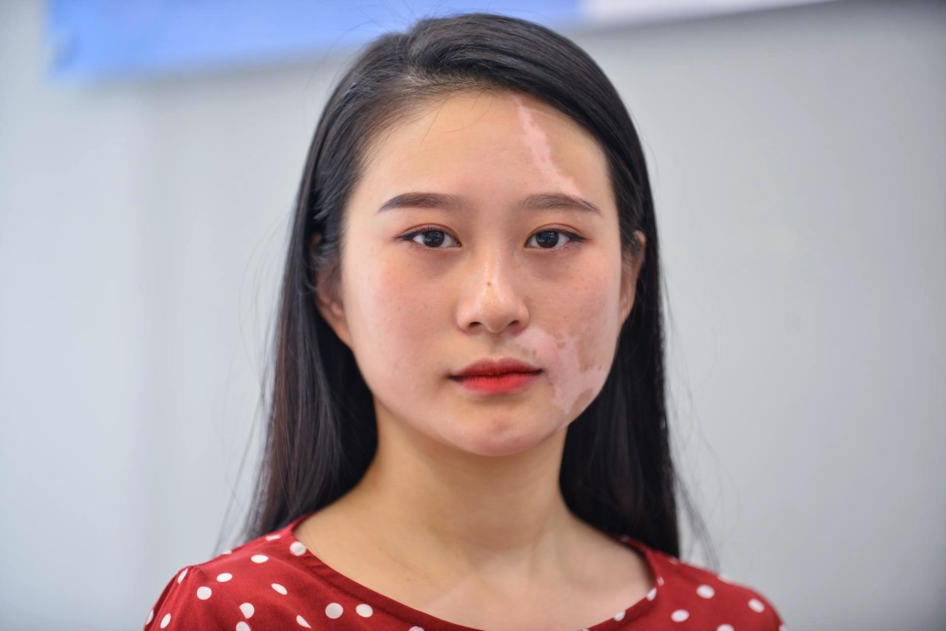 Vuot qua can benh bach bien anh 1