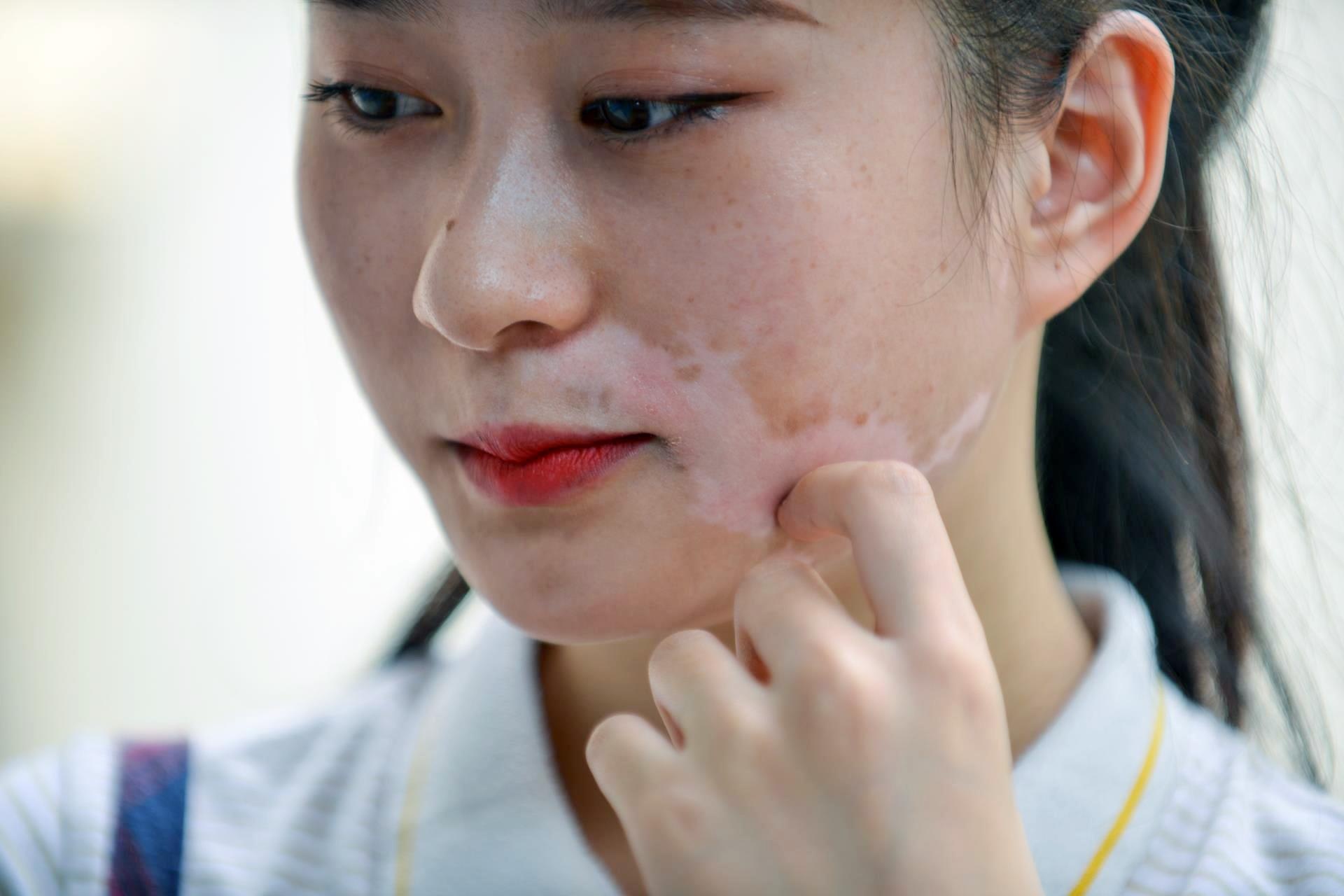 Vuot qua can benh bach bien anh 9