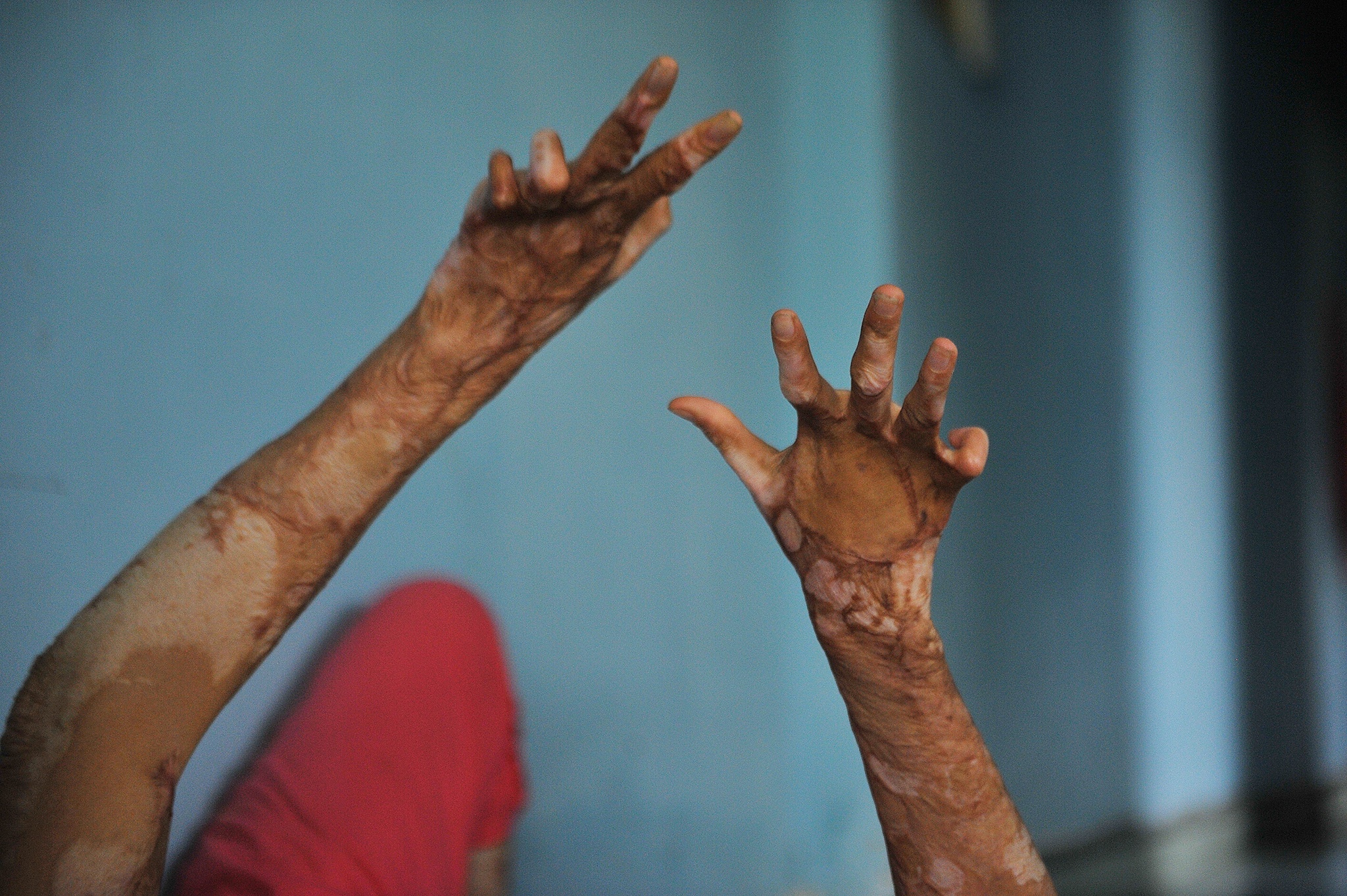 vo bi chong tuoi xang dot anh 7