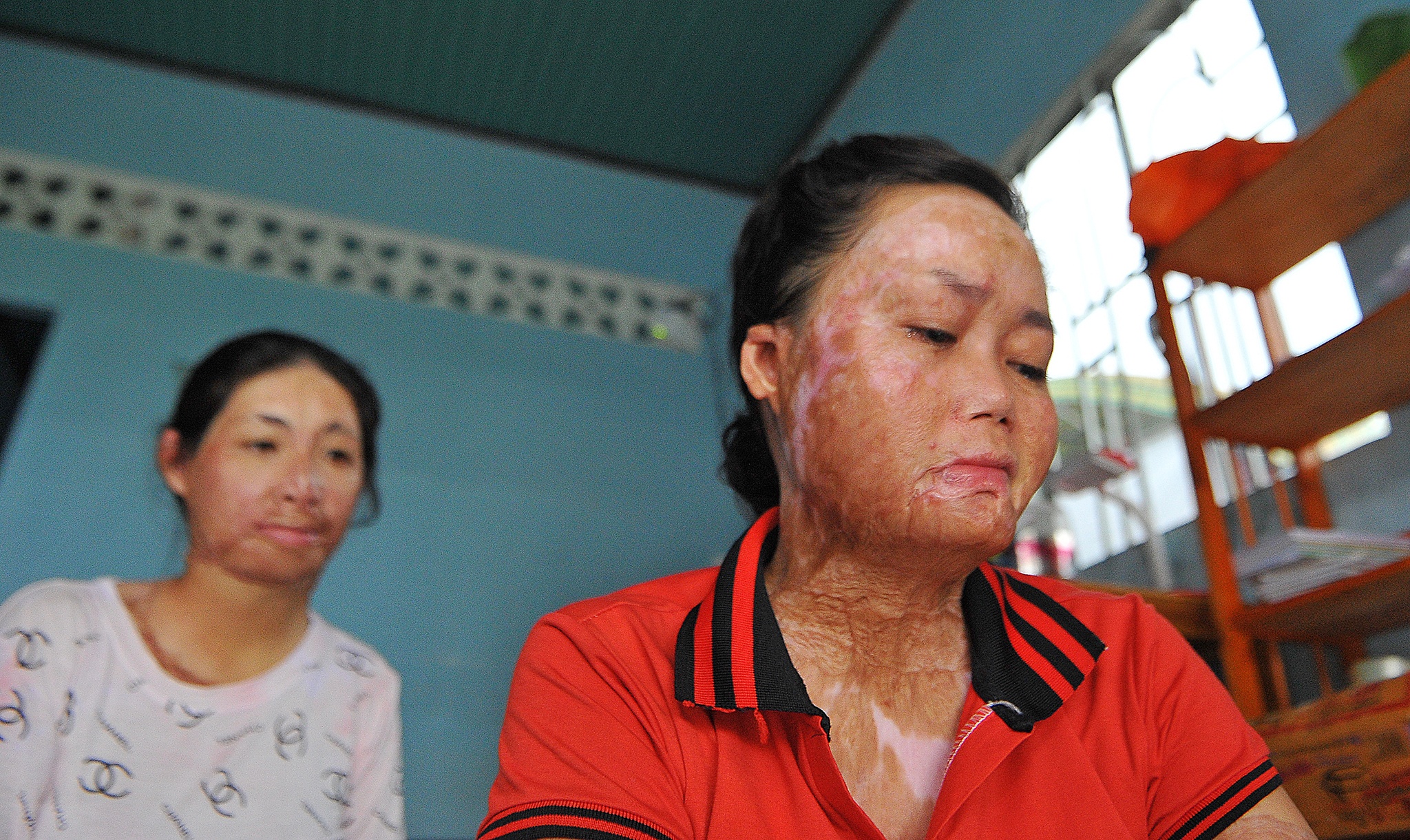 vo bi chong tuoi xang dot anh 3