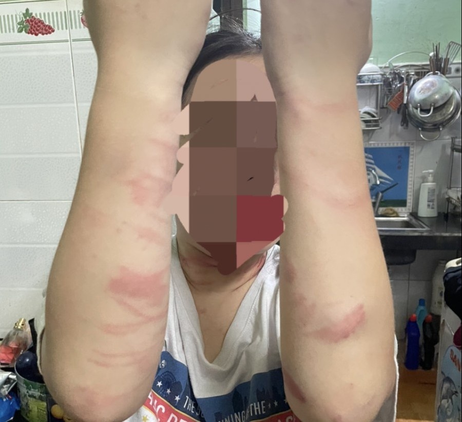 Thieu nu 17 tuoi o TP.HCM bi me danh gay nhieu thuong tich hinh anh