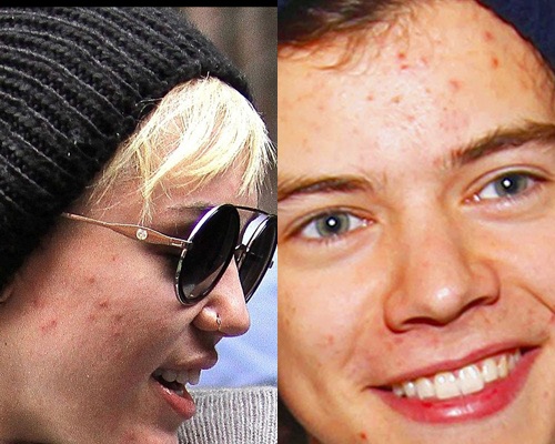 Nhung sao dau dau vi mun trung ca hinh anh