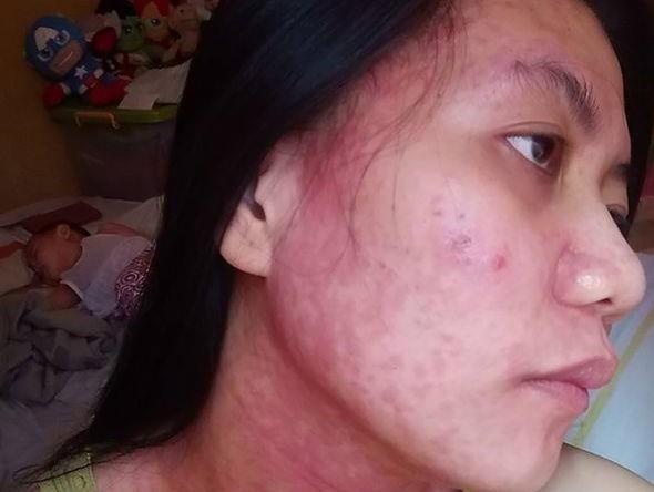 Thuy ngan trong kem lam trang da doc hai, nguy hiem den muc nao? hinh anh