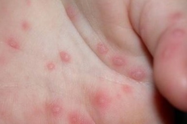 Benh tay chan mieng dung thuoc nhu the nao? hinh anh