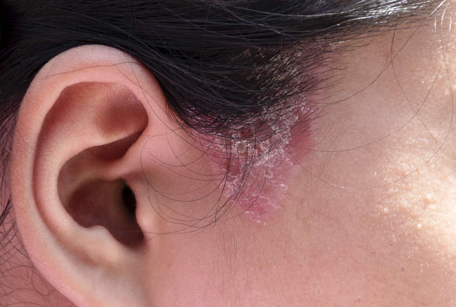 Benh nam da dau co lay qua tiep xuc? hinh anh