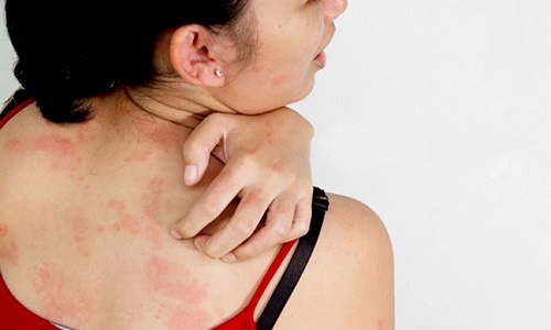 Khối lạ dưới da 'biết di chuyển', cảnh báo không nên bỏ qua