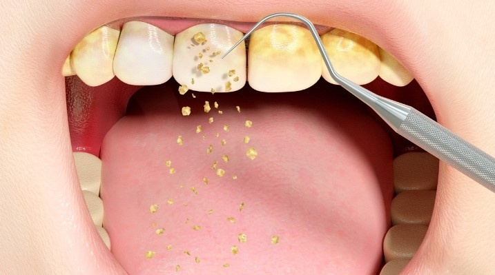 Khi nao nen cao voi rang? hinh anh