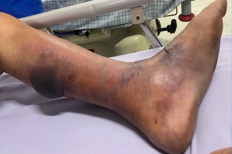 Nguoi dan ong nhiem lien cau lon sau 5 ngay an tiet mua o cho hinh anh