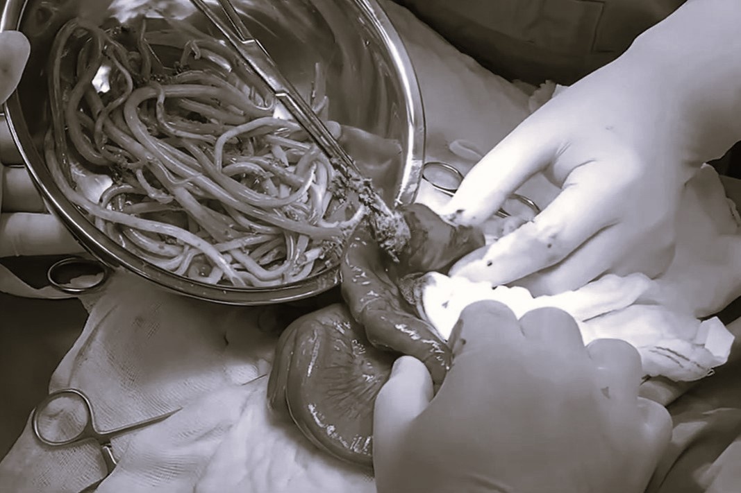 Dieu dang lo qua su viec gap hon 100 con giun trong ruot be trai hinh anh