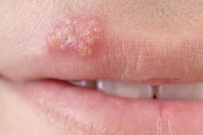 herpes sinh duc anh 1