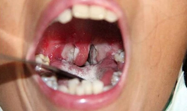 Bien chung nguy hiem cua benh bach hau hinh anh