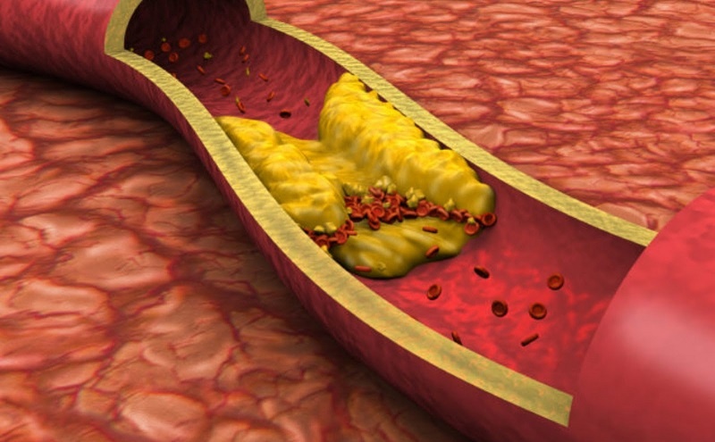 roi loan chuyen hoa lipid anh 1