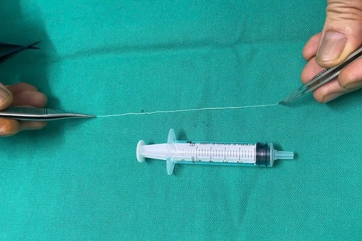 Bac si bat ngo khi gap giun dai 14 cm tu mat nguoi phu nu hinh anh