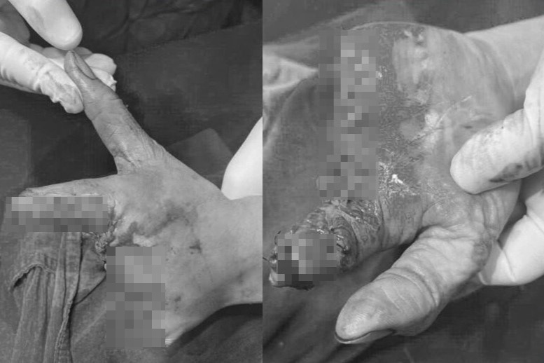 Nguoi phu nu di cap cuu voi ban tay dap nat hinh anh