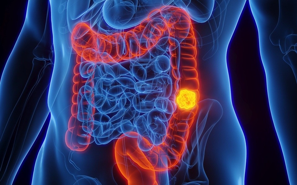 4 dau hieu canh bao cua ung thu dai truc trang hinh anh