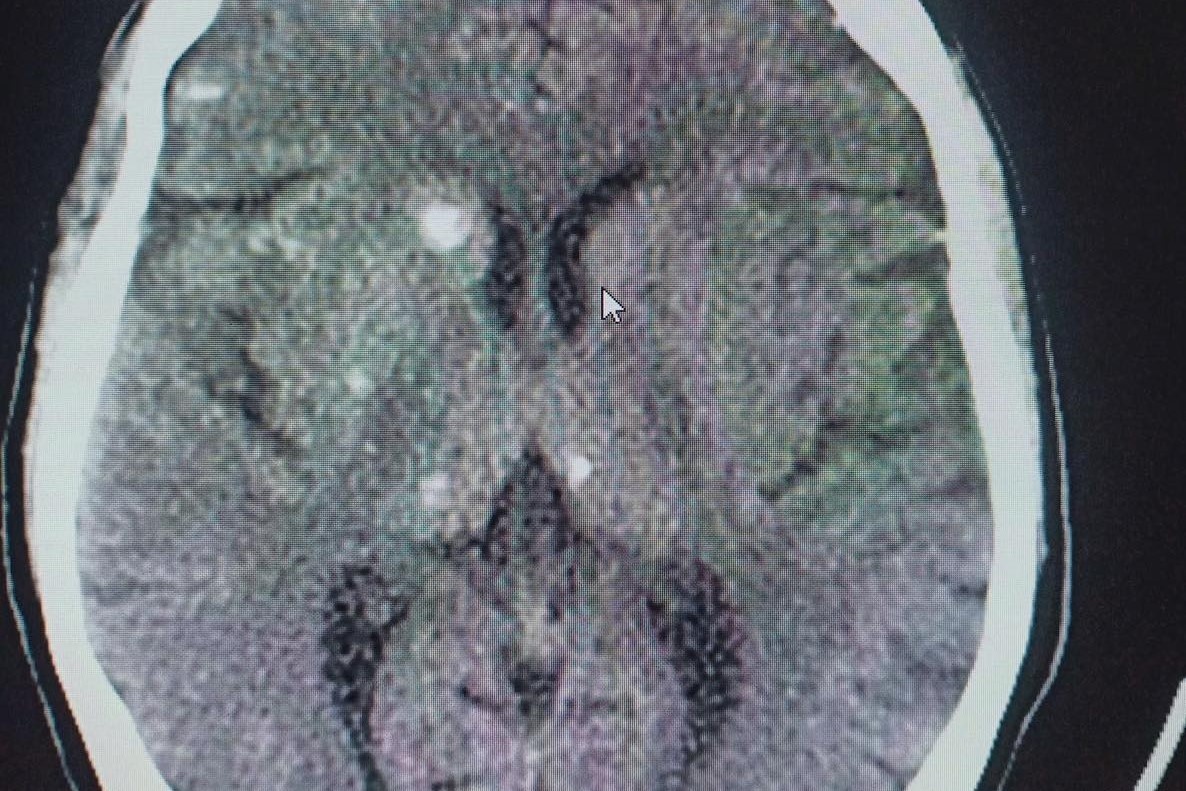 Anh chup CT gay soc cua benh nhan nhiem san nao hinh anh