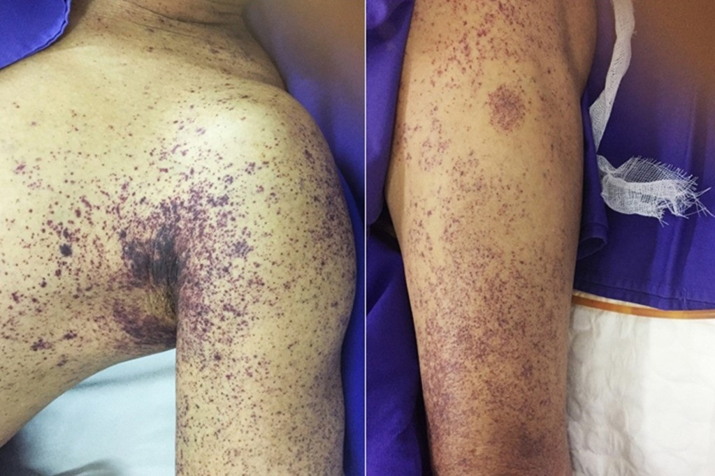 Ganh hau qua vi thuong xuyen an tiet canh, do tai song hinh anh