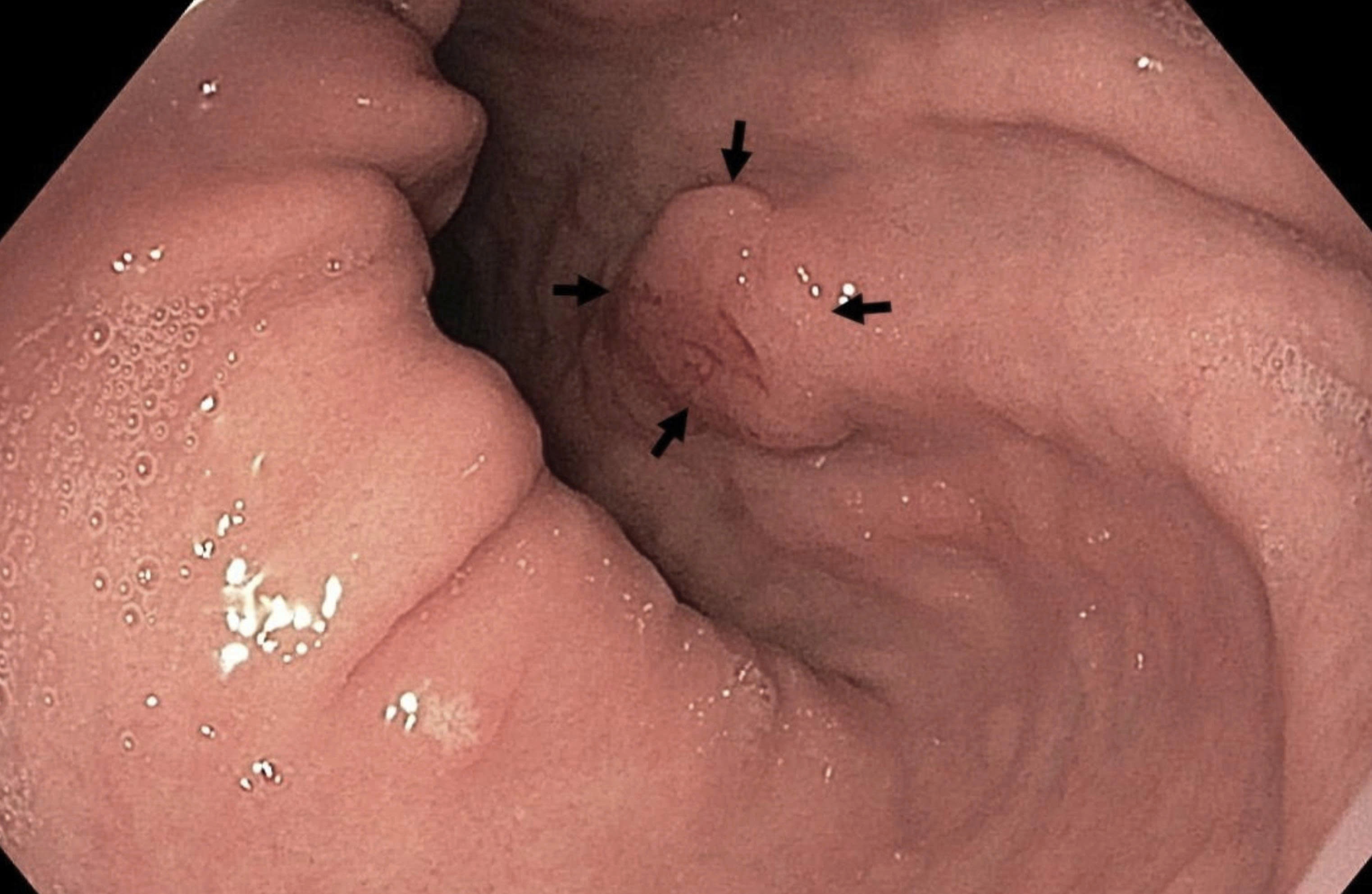 Nguoi phu nu co dau hieu ung thu da day nhung khong hay biet hinh anh