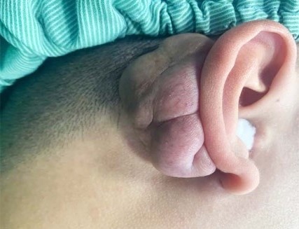 Giai cuu vanh tai cho nam thanh nien 22 tuoi mac ung thu hinh anh