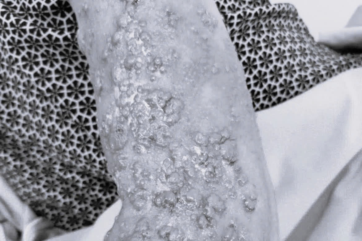 Dung dau gio de tri benh, nguoi phu nu ganh hau qua hinh anh