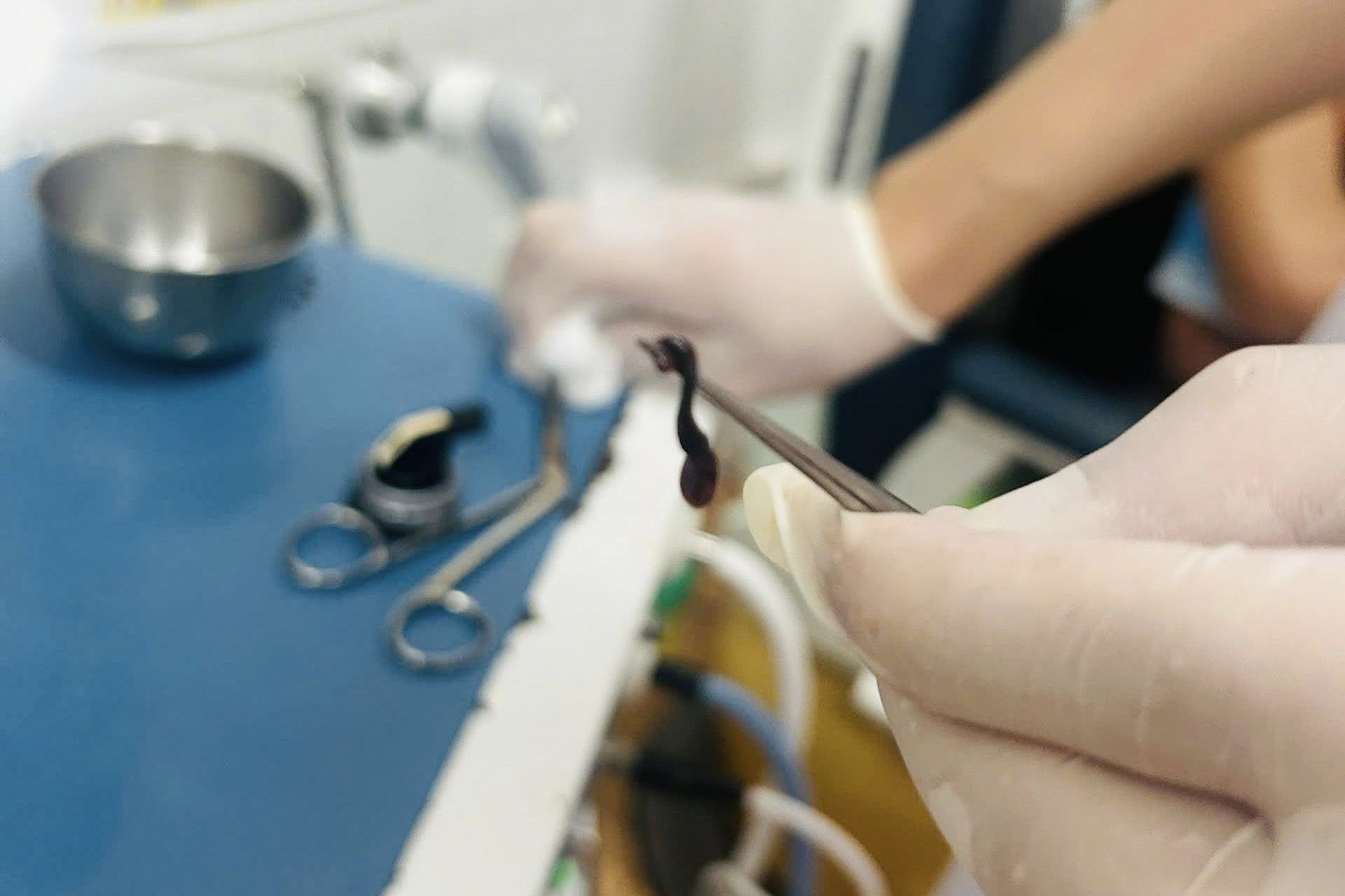 Gap con dia dai 5 cm ky sinh trong mui be trai hinh anh