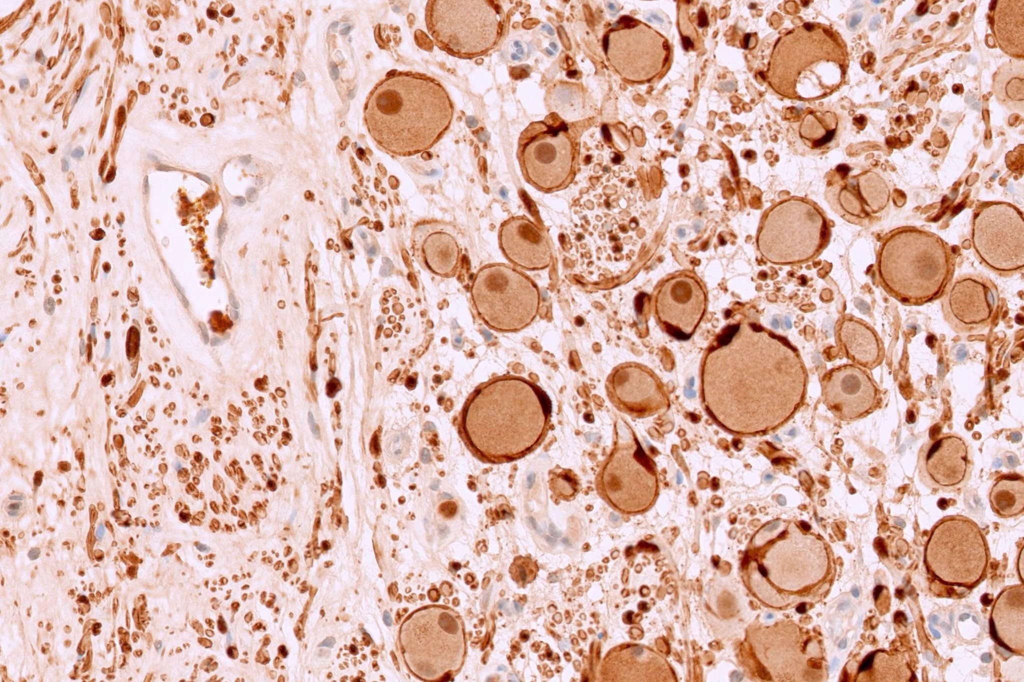 Dang dieu tri bien chung soi, be trai duoc phat hien khoi u hiem hinh anh