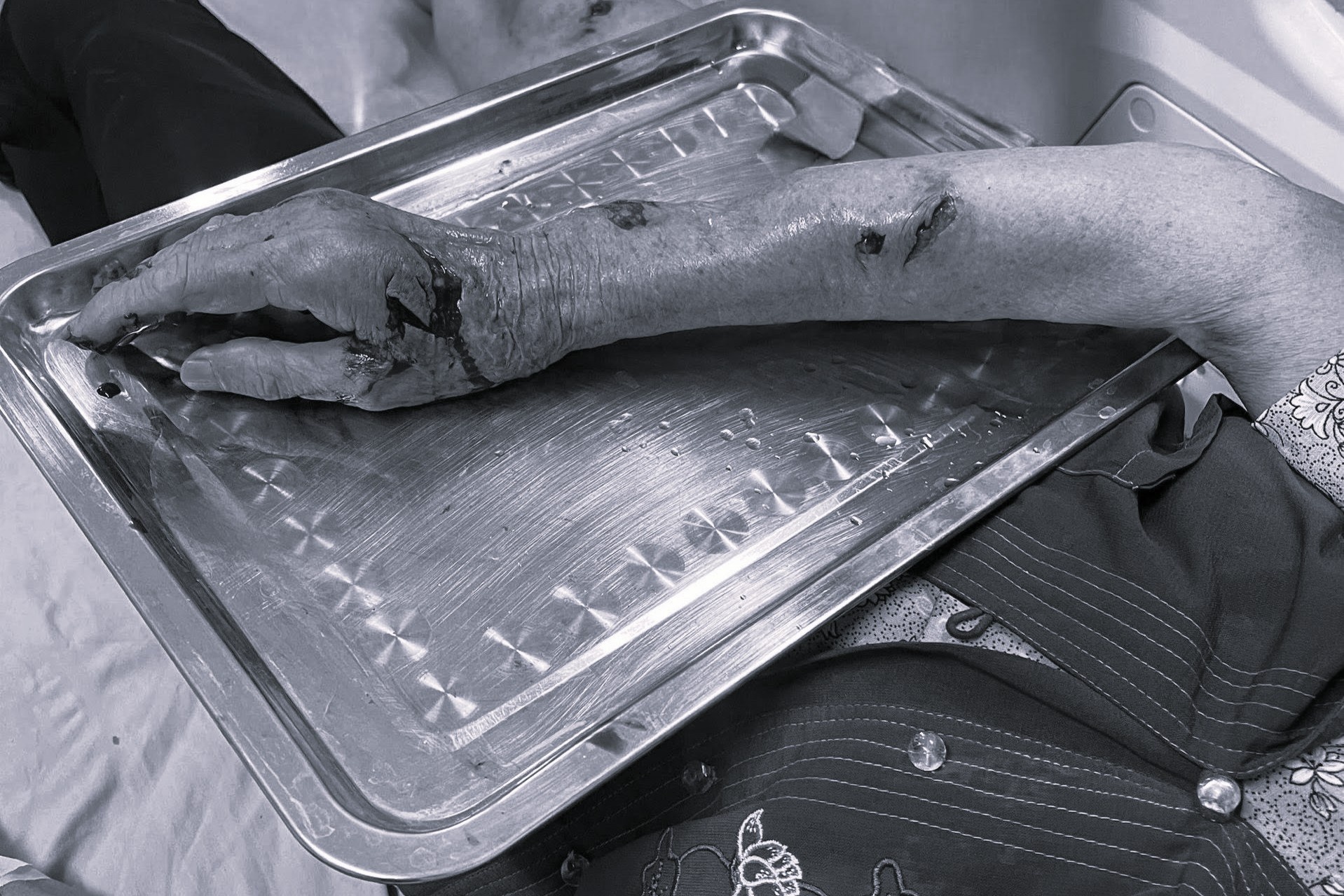 Nguoi phu nu bi cho nha tan cong, nhieu vet thuong khap co the hinh anh