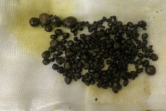 Gan 400 vien soi trong tui mat nguoi phu nu hinh anh