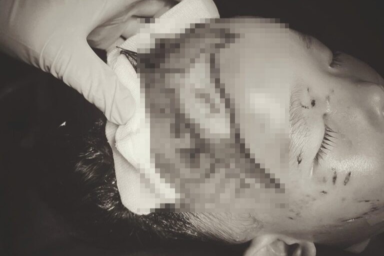 Be trai 2 tuoi bi cho can lo so nao hinh anh