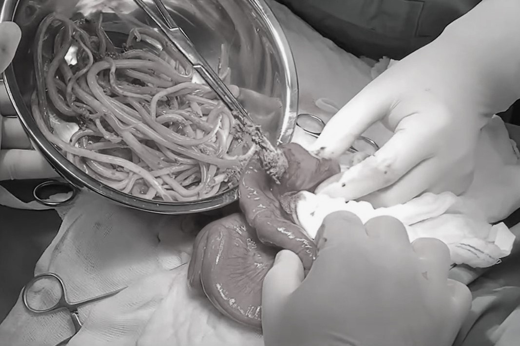 Thieu nien 15 tuoi bi loet ruot nang, ben trong chua day giun dua hinh anh