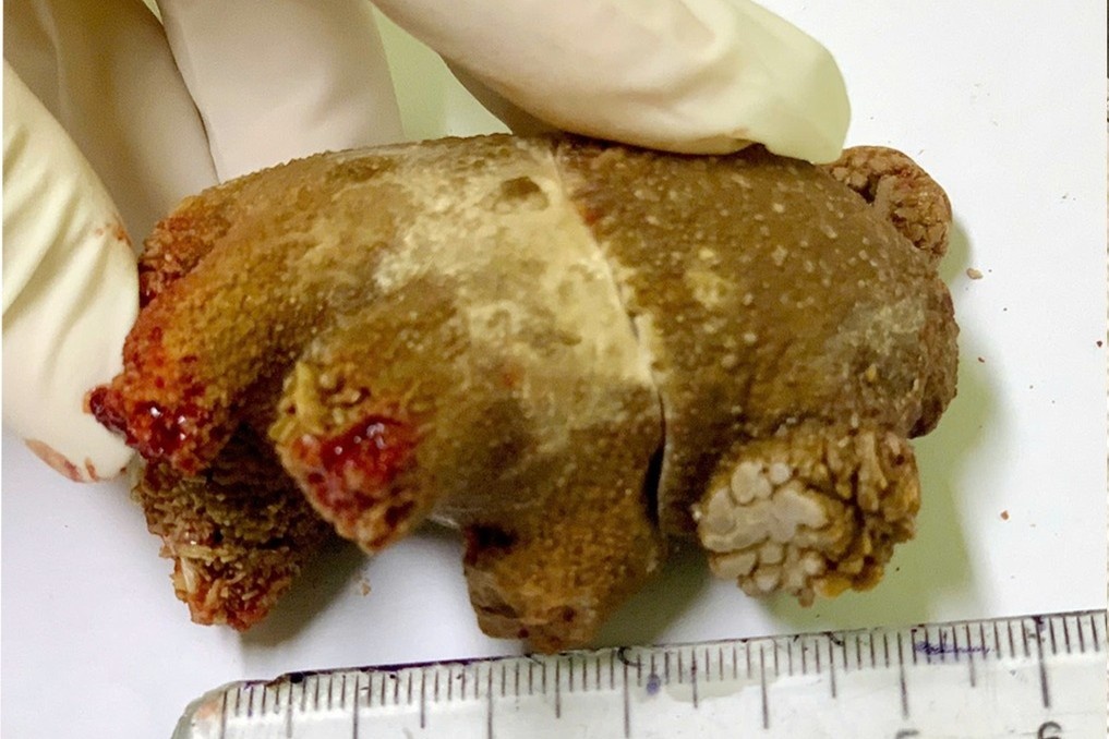 Vien soi san ho khong lo trong than nguoi dan ong suot 20 nam hinh anh