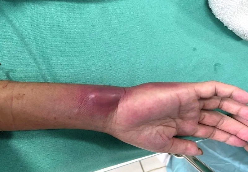 2 ca nhiem vi khuan ‘an thit nguoi’ o Dak Lak hinh anh