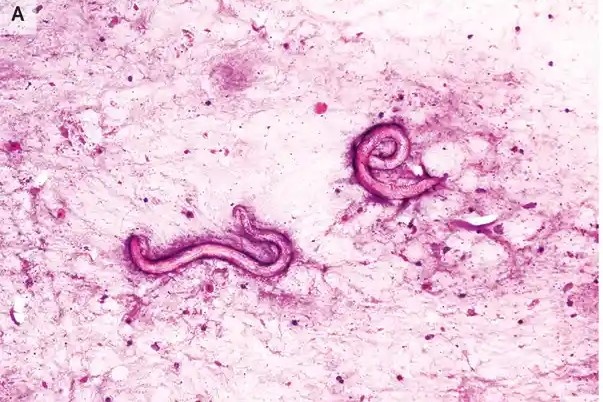 Ghep than mang theo ky sinh trung, 2 nguoi dan ong nhap vien gap hinh anh