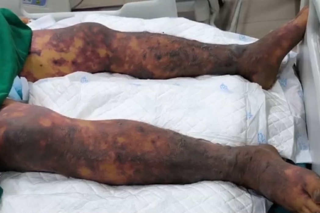 Vi khuan lien cau lon lay sang nguoi nhu the nao? hinh anh