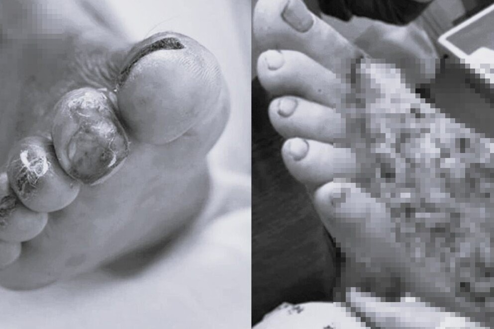 Loai vi khuan 'an thit nguoi' an minh trong mon hai san hinh anh