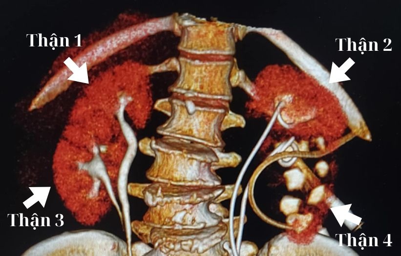 Bat ngo phat hien nguoi phu nu o TP.HCM co 4 qua than hinh anh