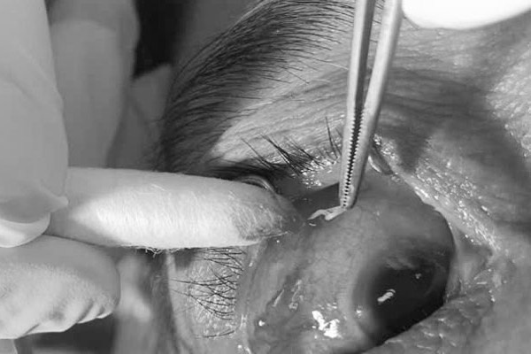 Bat ngo phat hien giun trong mat nguoi phu nu hinh anh