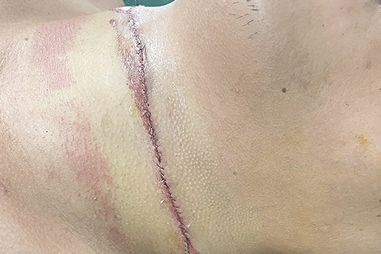 Nam thanh nien bi day thep cua ngang co khi dang di xe may hinh anh