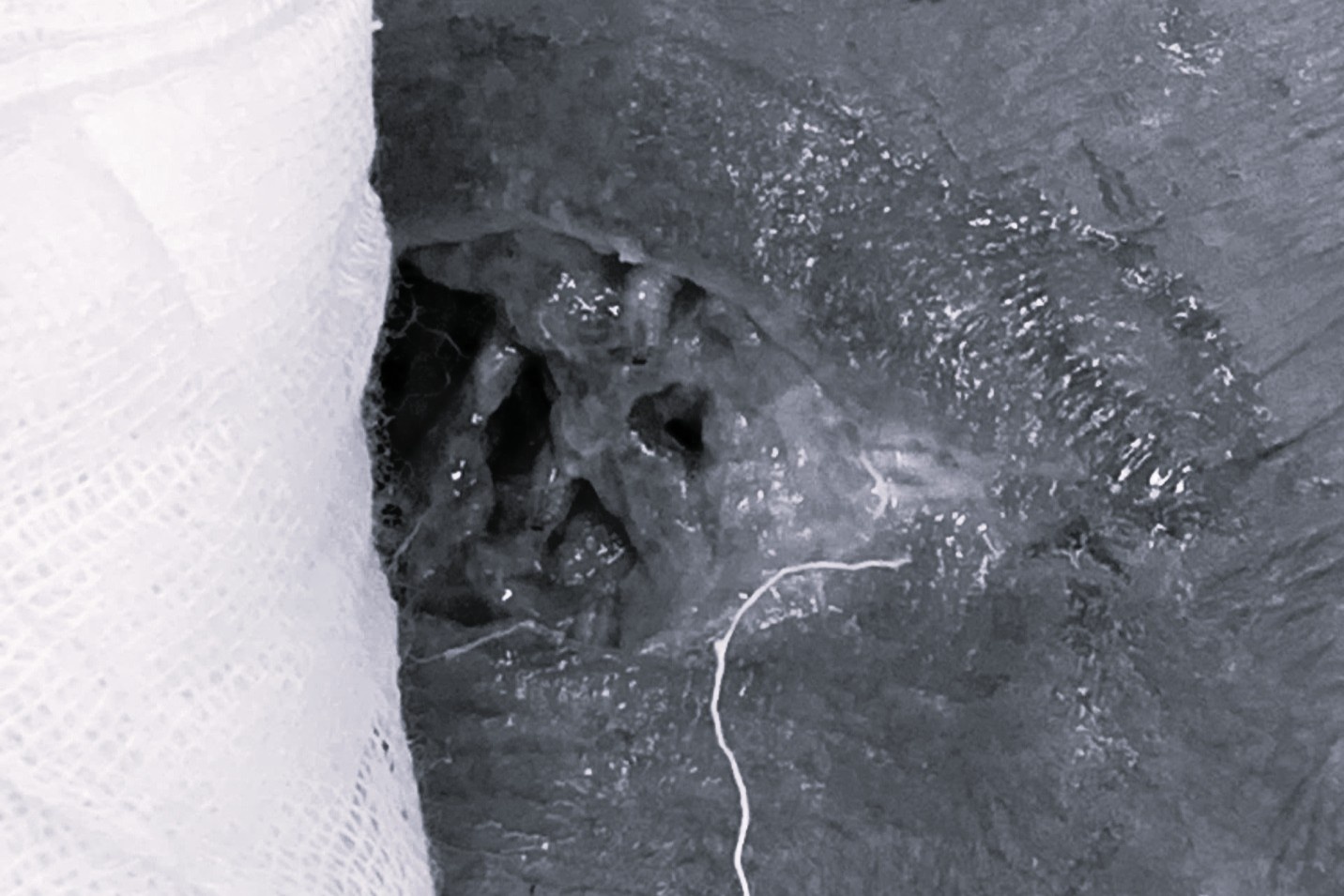 Hinh anh trong o viem cua benh nhan khien bac si Phu Tho soc hinh anh