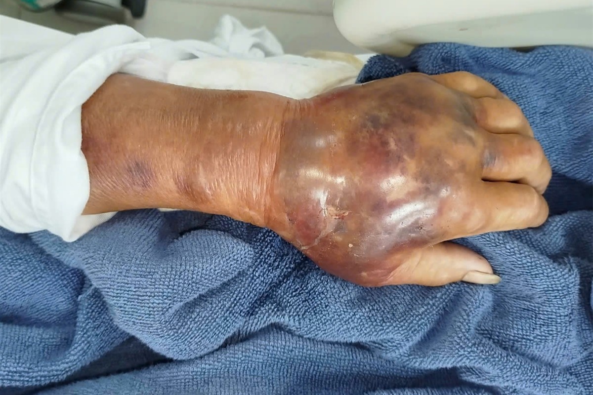 Vet thuong nho o ban tay bien thanh con bao benh hinh anh